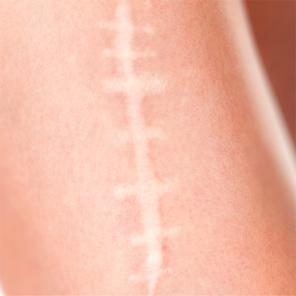 dermopigmentation-reparatrice-cicatrices-vergetures
