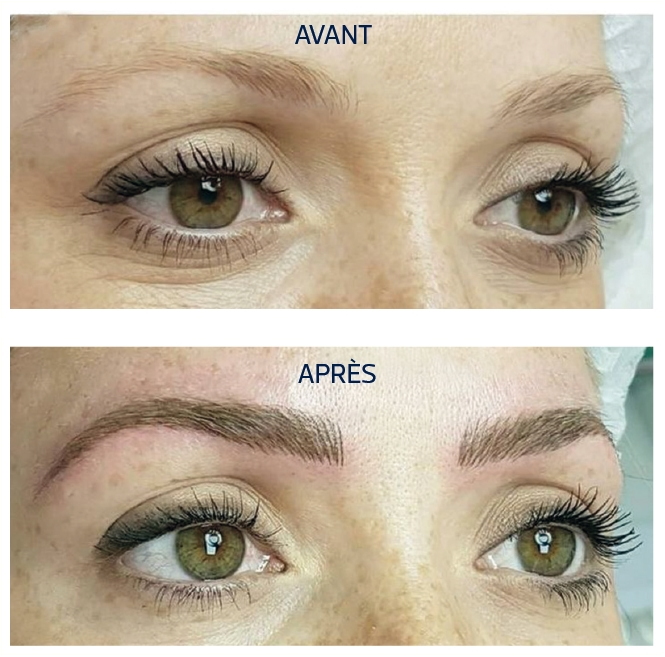 dermopigmentation-sorucils