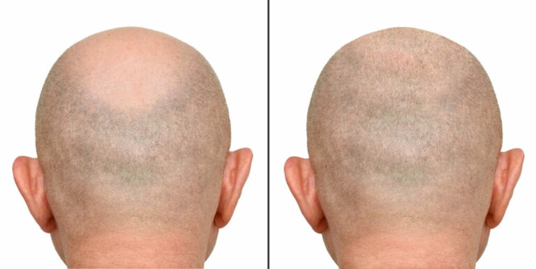 tricopigmentation-avant-apres-1-effet-rase-1024x515